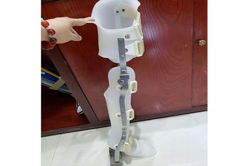 假肢與矯形器的使用周期與更換指南 科學維護，保障生活品質